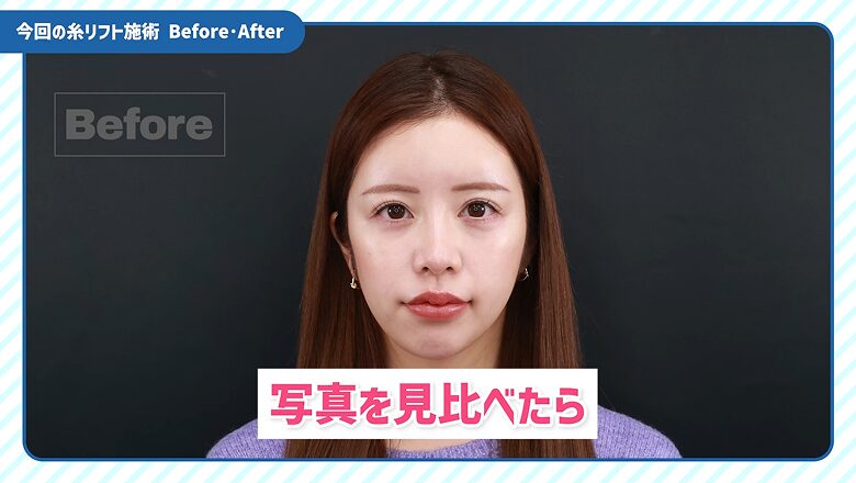 今回の糸リフト施術前の正面写真(Before)