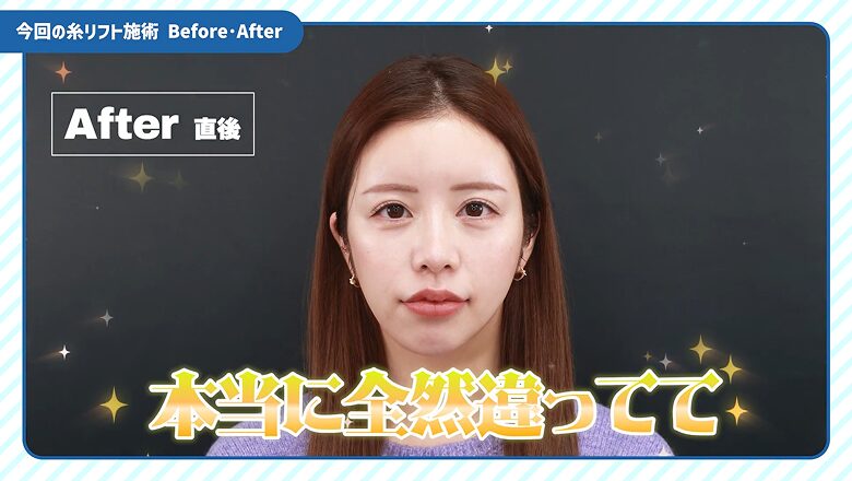 今回の糸リフト施術直後の正面写真(After)