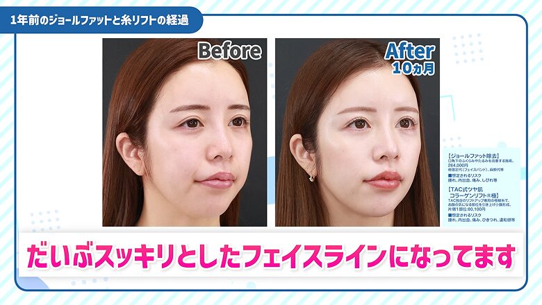 前回の施術前と10カ月後のフェイスライン比較写真