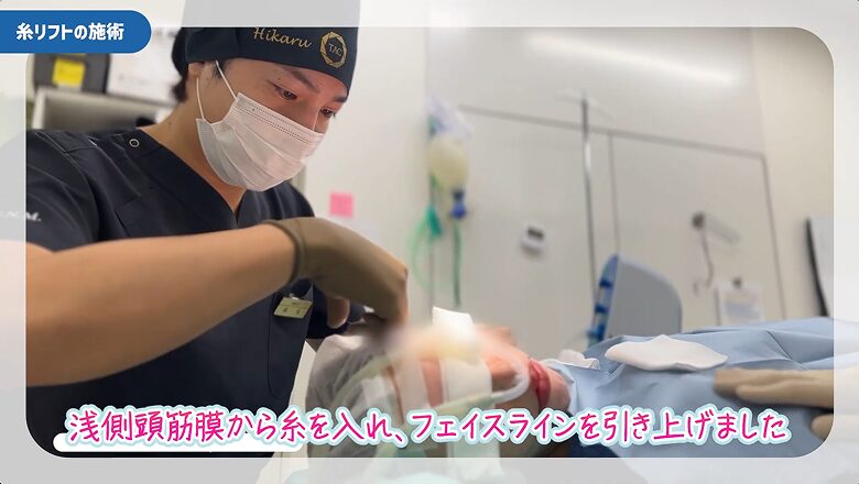 浅側頭筋膜から糸を挿入しフェイスラインを引き上げる施術の様子