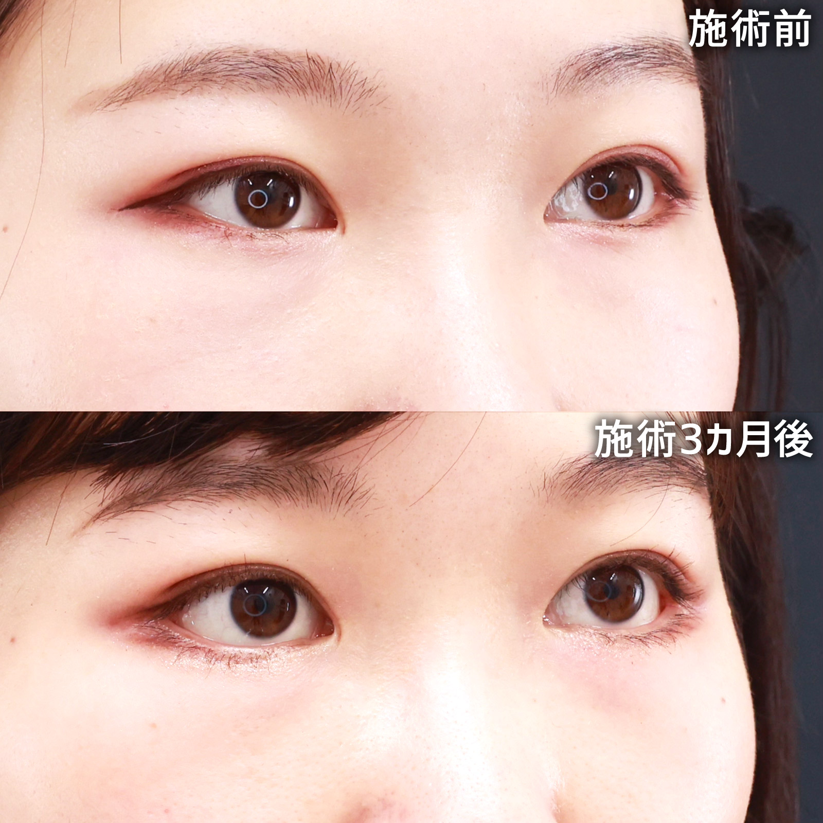 グラマラスライン（タレ目形成）/目尻靭帯移動術/目尻切開術の症例写真 施術前後 