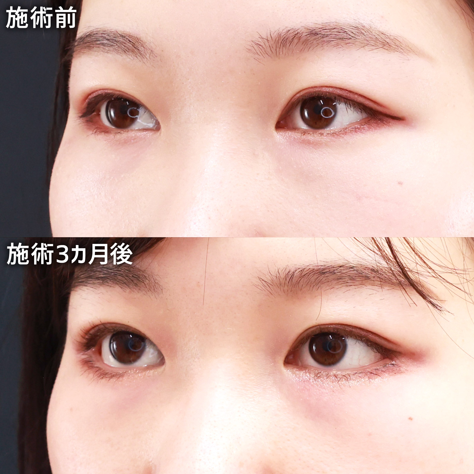 グラマラスライン（タレ目形成）/目尻靭帯移動術/目尻切開術の症例写真 施術前後 