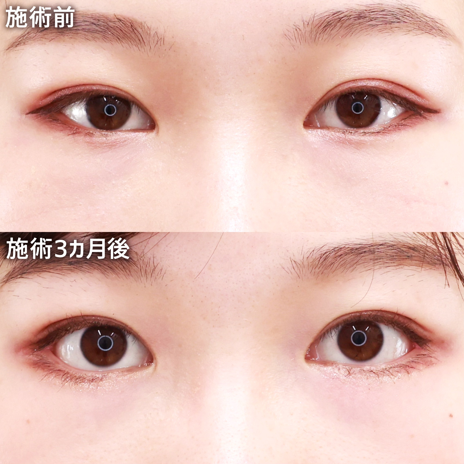 【グラマラスライン】たれ目フルセットでツリ目解消！ダウンタイムもご紹介