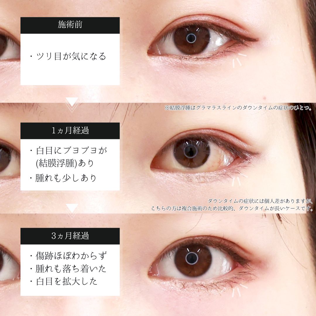 グラマラスライン（タレ目形成）/目尻靭帯移動術/目尻切開術の症例写真 施術前後 