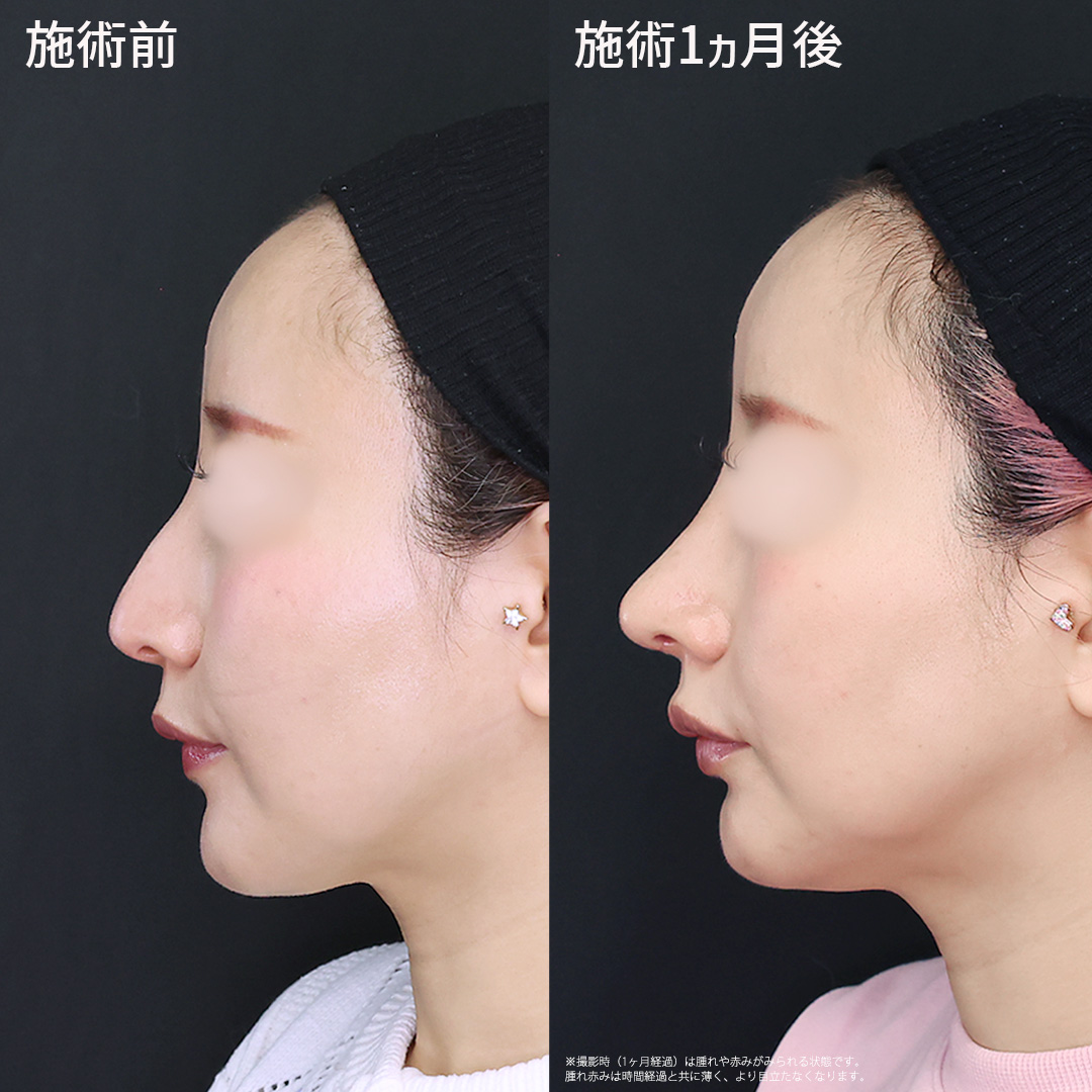 【他院修正】より洗練されたデザインの鼻整形