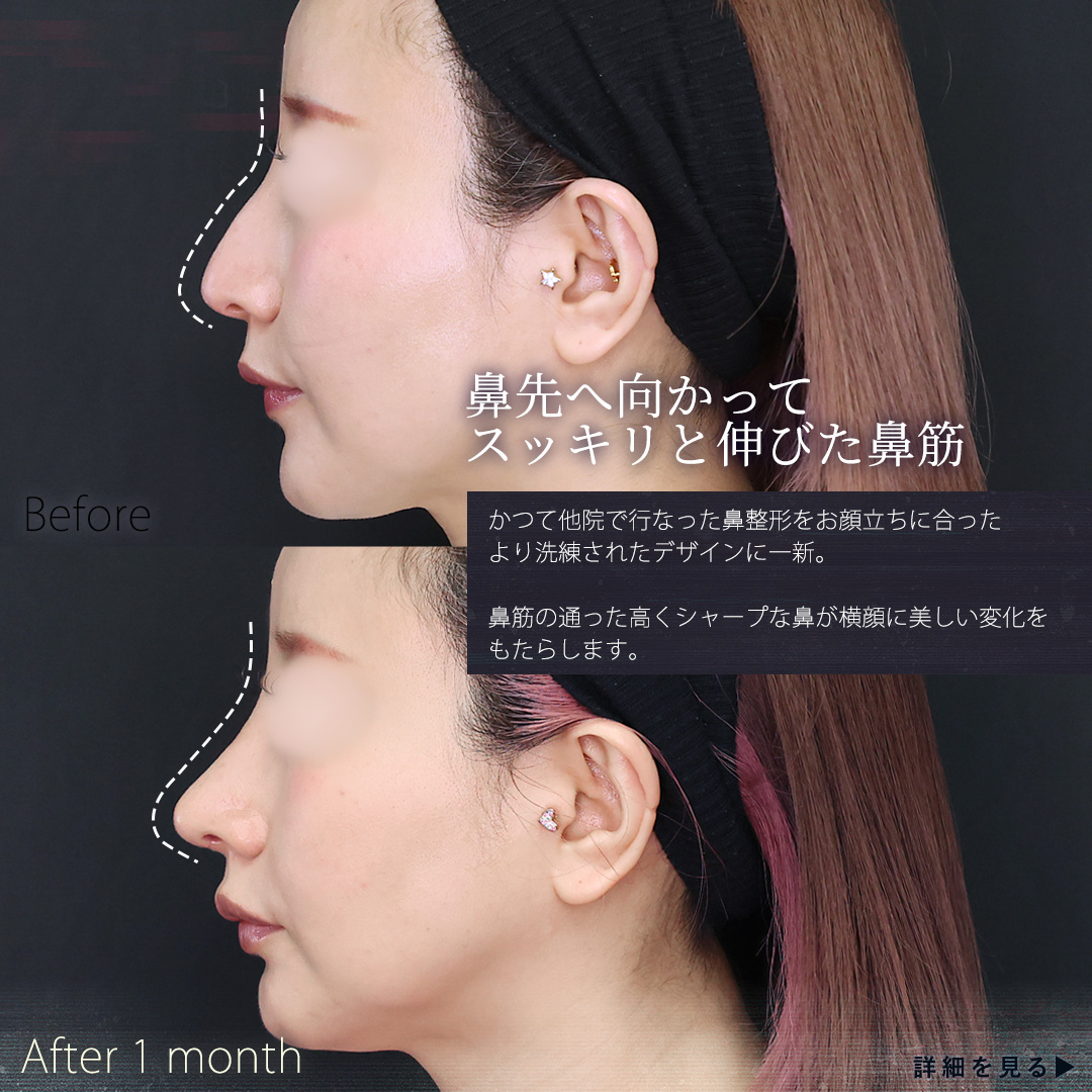 鼻中隔延長術/鼻先軟骨移植/鼻孔縁挙上術の症例写真 施術前後