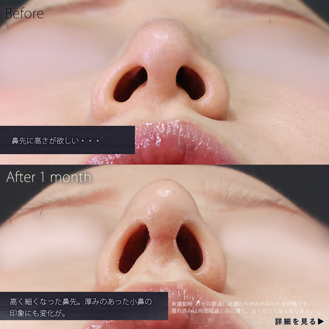 鼻中隔延長術/鼻先軟骨移植/鼻孔縁挙上術の症例写真 施術前後