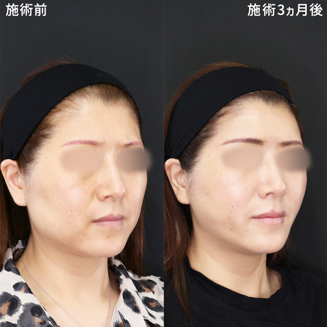 ナチュラルに若返る！脂肪除去×ヒアルロン酸注入【若返り複合施術】