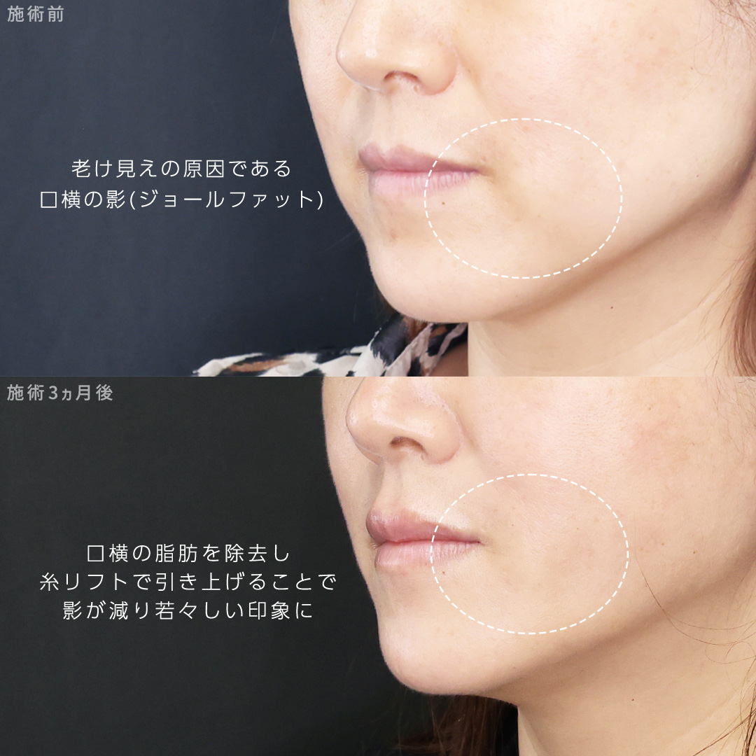 TAC式 ツヤ肌コラーゲンリフト®/ジョールファット除去/顔の脂肪吸引の症例写真 施術前後 