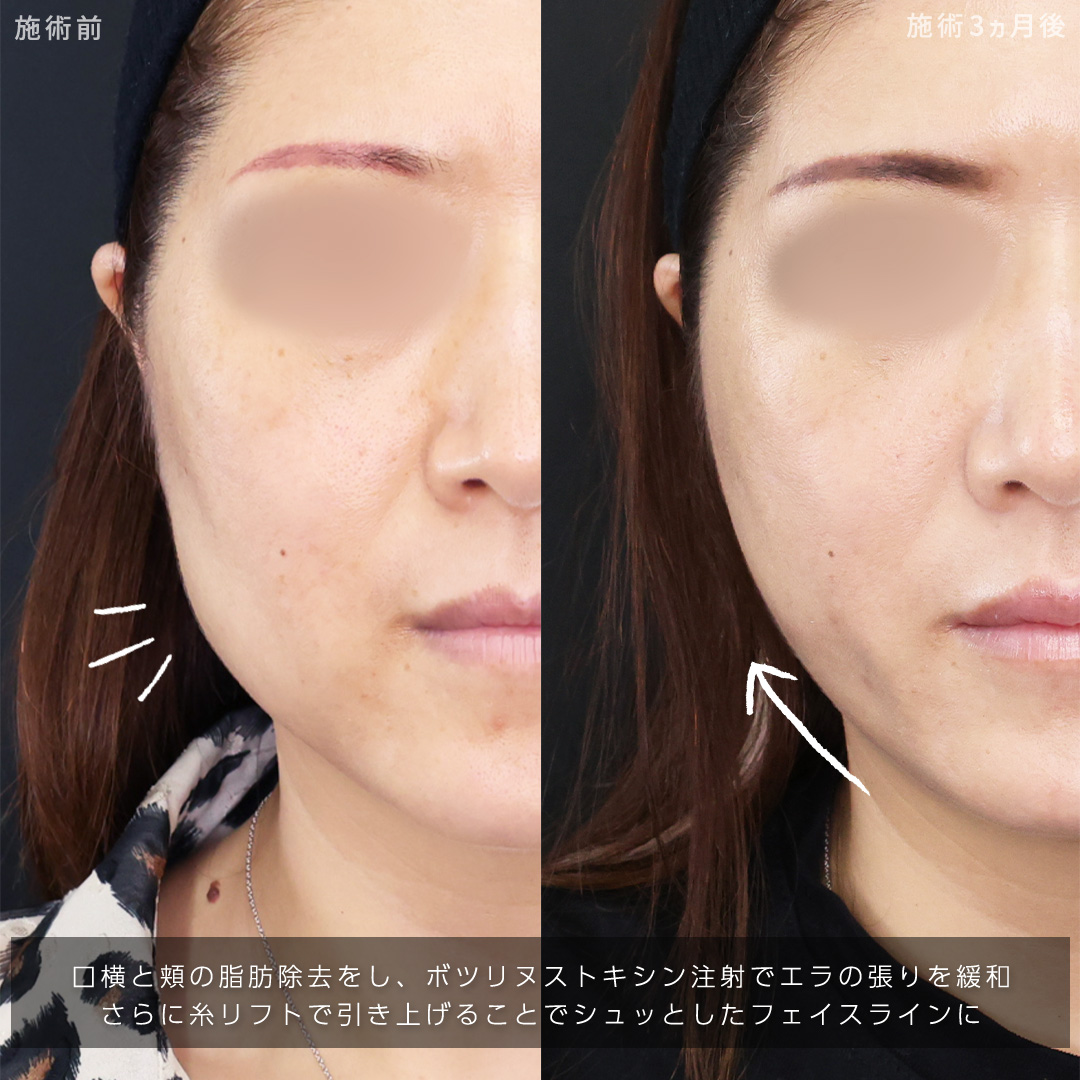 TAC式 ツヤ肌コラーゲンリフト®/ジョールファット除去/顔の脂肪吸引の症例写真 施術前後 
