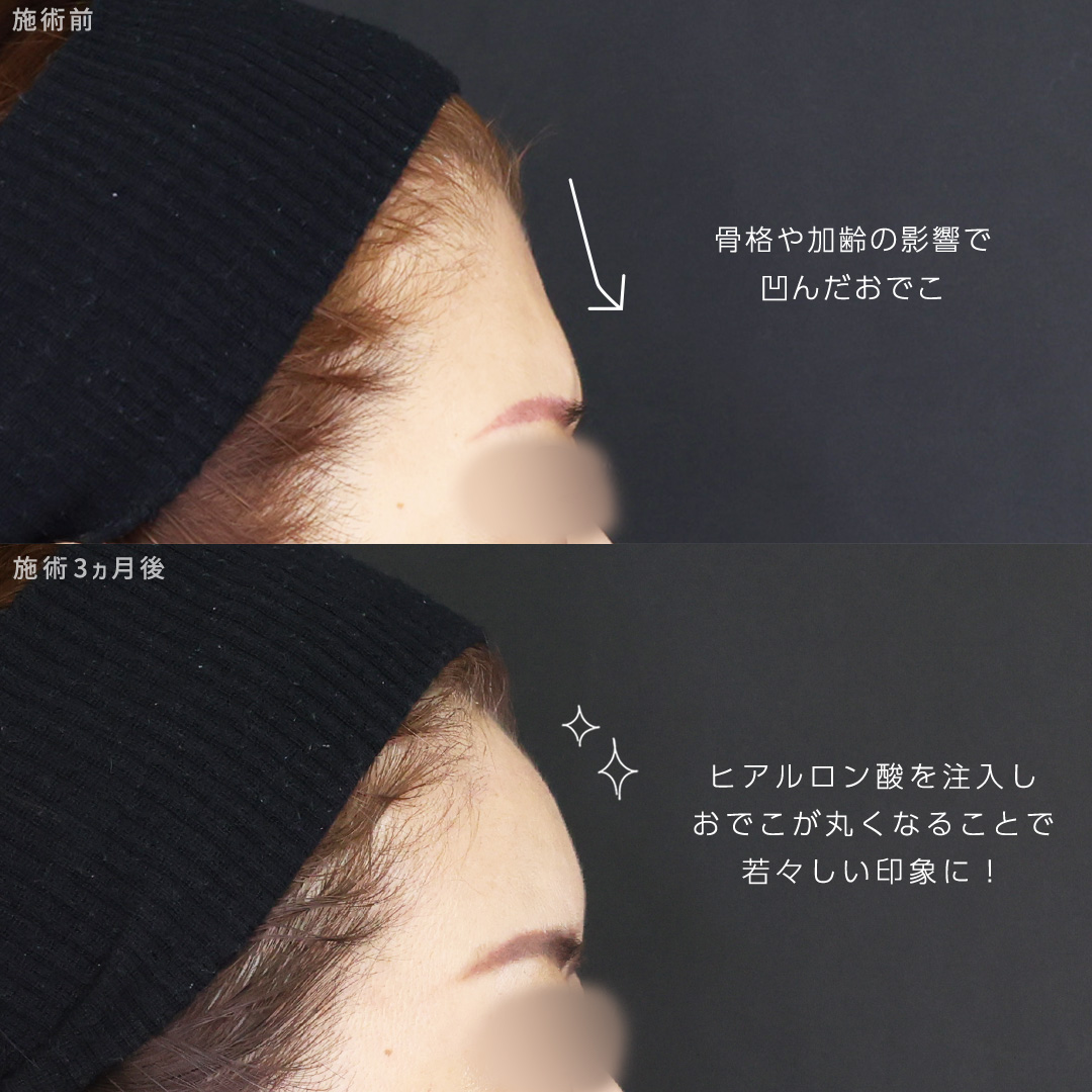 TAC式 ツヤ肌コラーゲンリフト®/ジョールファット除去/顔の脂肪吸引の症例写真 施術前後 