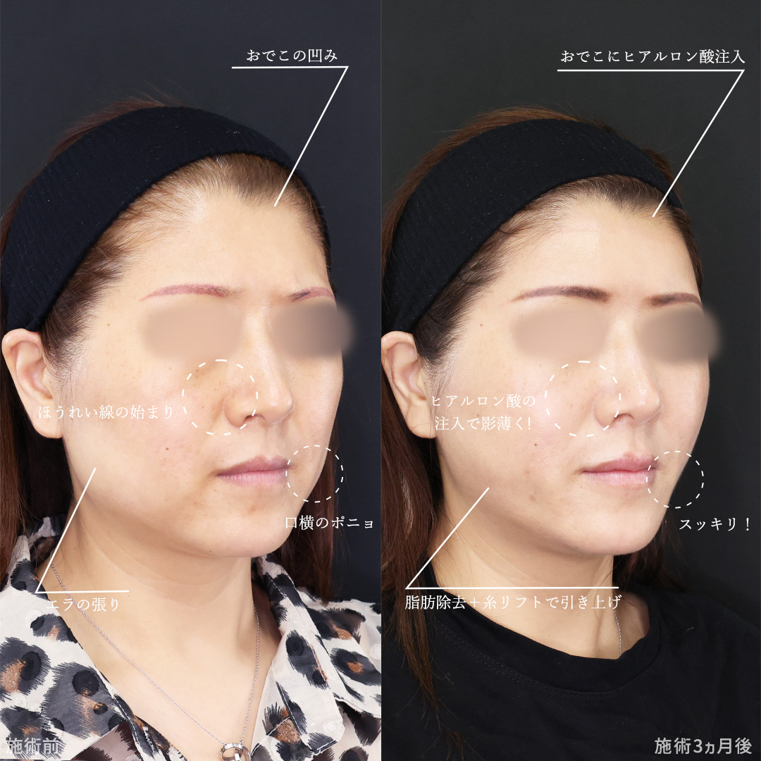 TAC式 ツヤ肌コラーゲンリフト®/ジョールファット除去/顔の脂肪吸引の症例写真 施術前後 