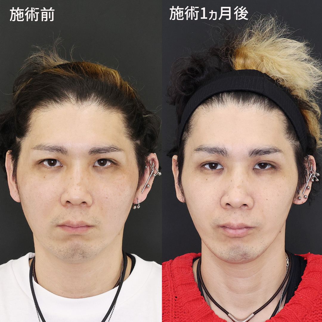 【メンズ小顔整形】本来の輪郭を引き出して垢抜け