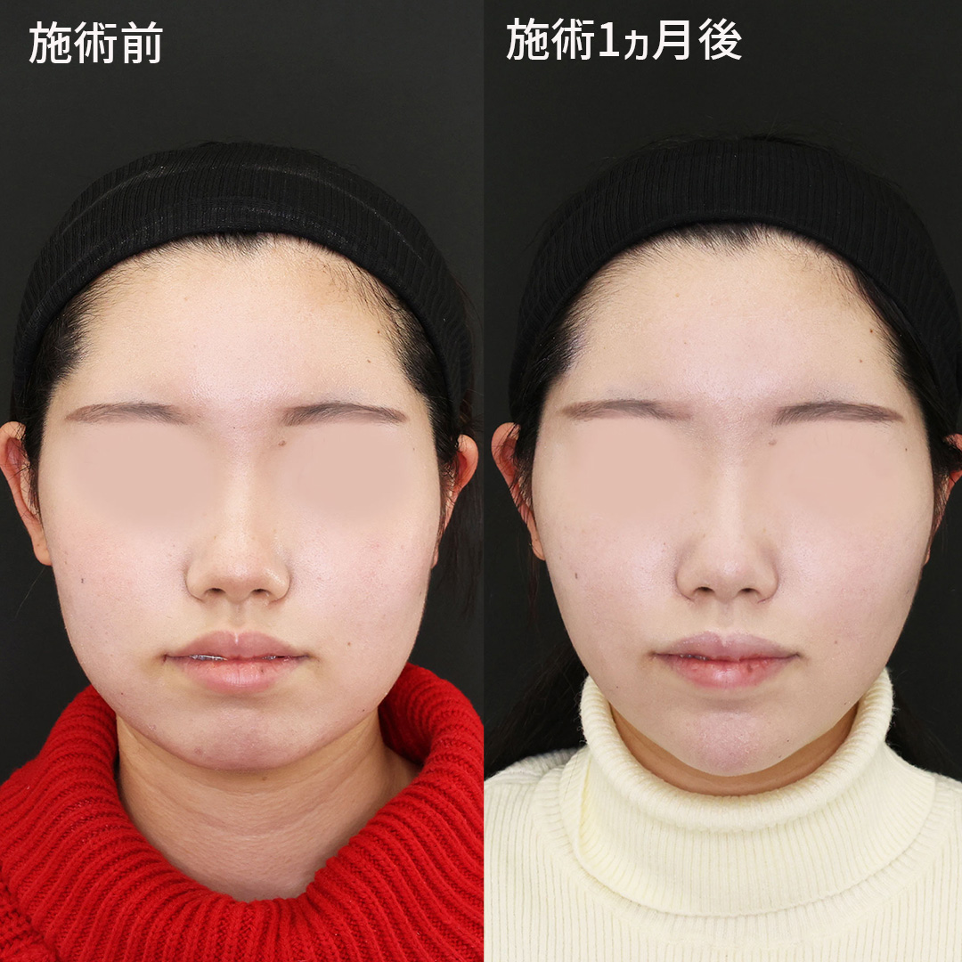 【垢抜け小顔術】糸リフトで理想のフェイスラインを手に入れる