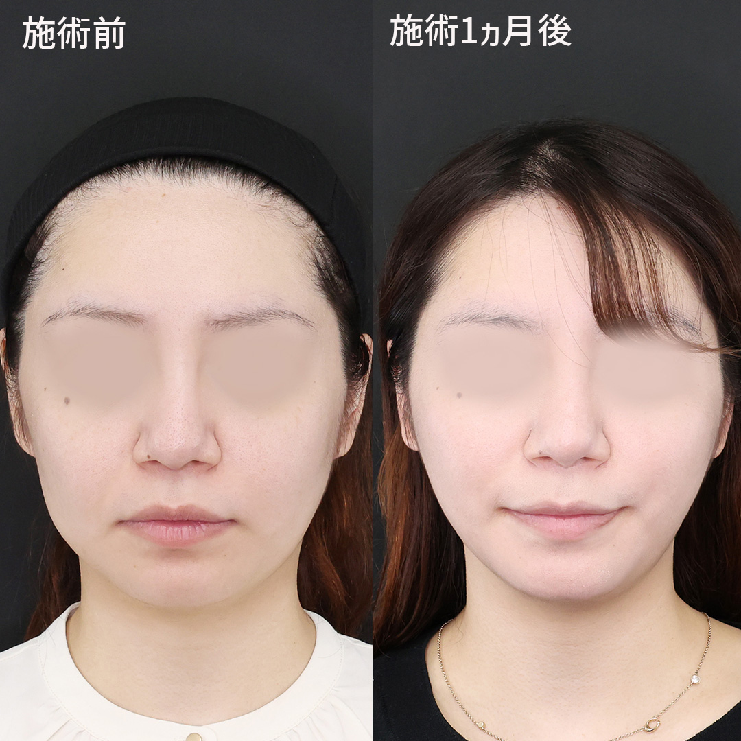 【糸リフト×エラボト】確実な変化をもたらす究極の小顔術