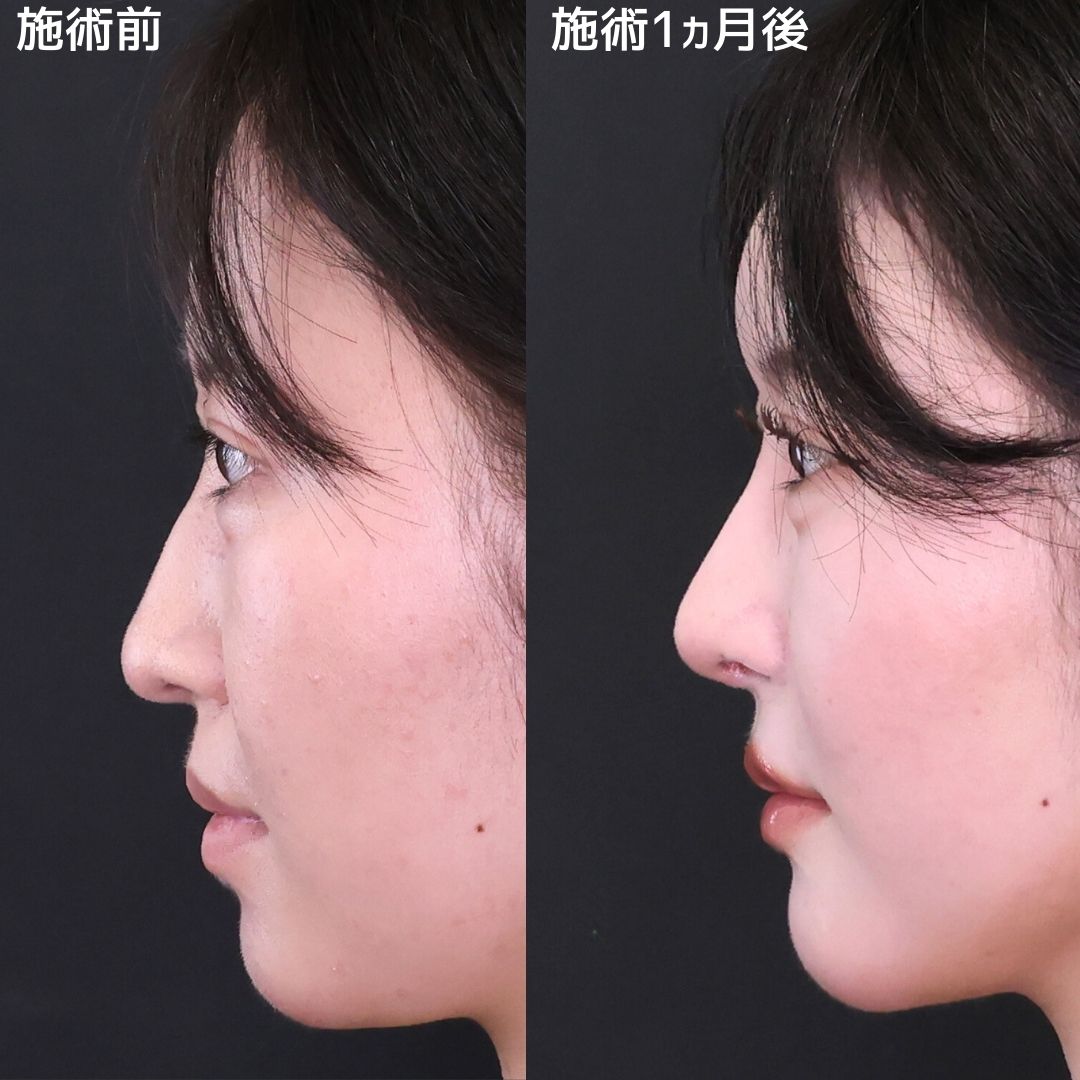 【鼻整形】究極の忘れ鼻でアイドル級