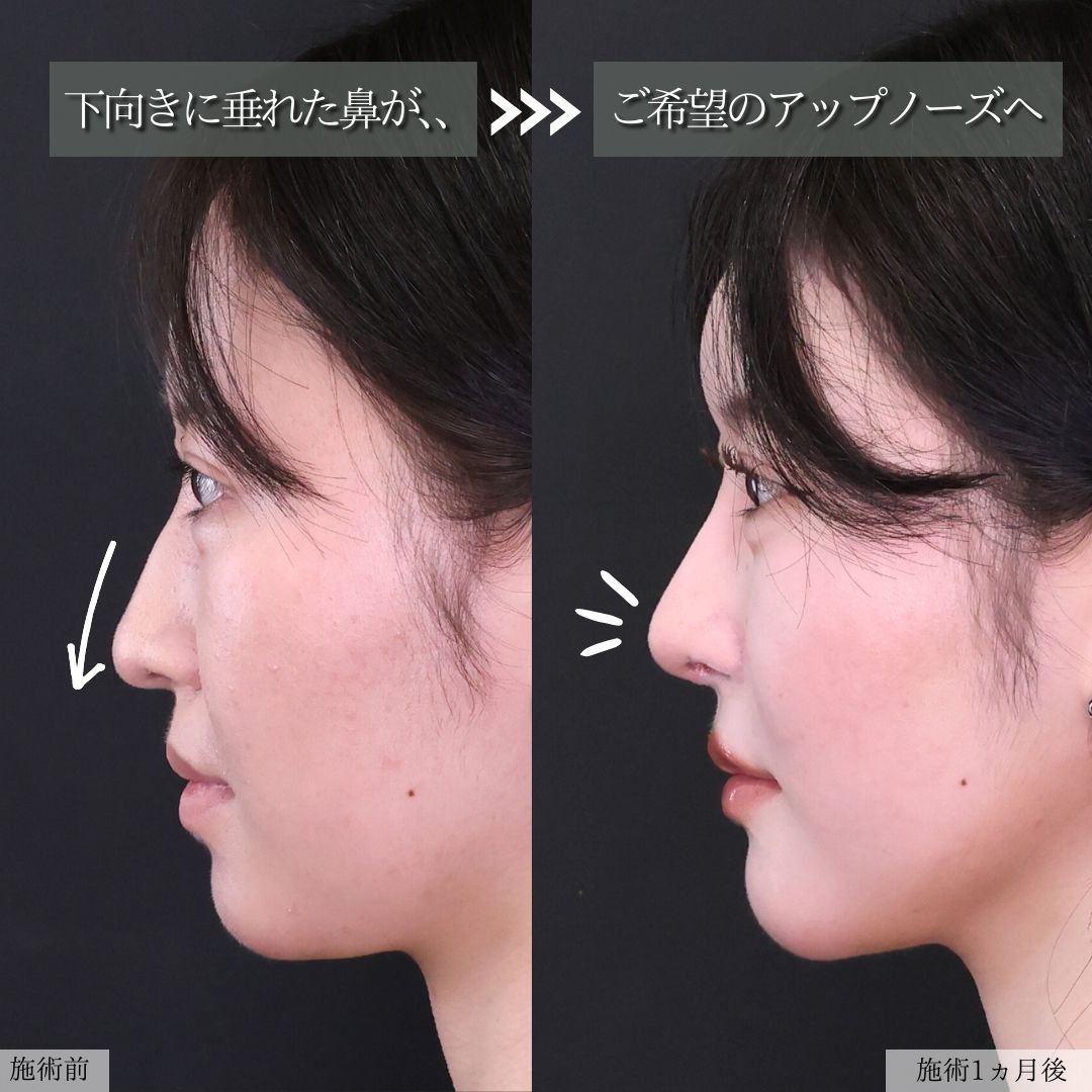 鼻先軟骨移植/鼻尖形成・鼻尖縮小/隆鼻術（プロテーゼ・自家組織）の症例写真 施術前後 