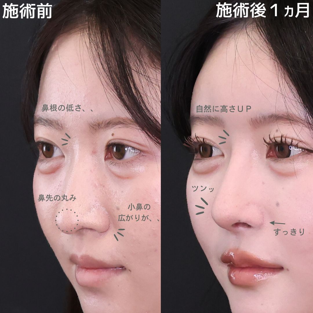 鼻先軟骨移植/鼻尖形成・鼻尖縮小/隆鼻術（プロテーゼ・自家組織）の症例写真 施術前後 