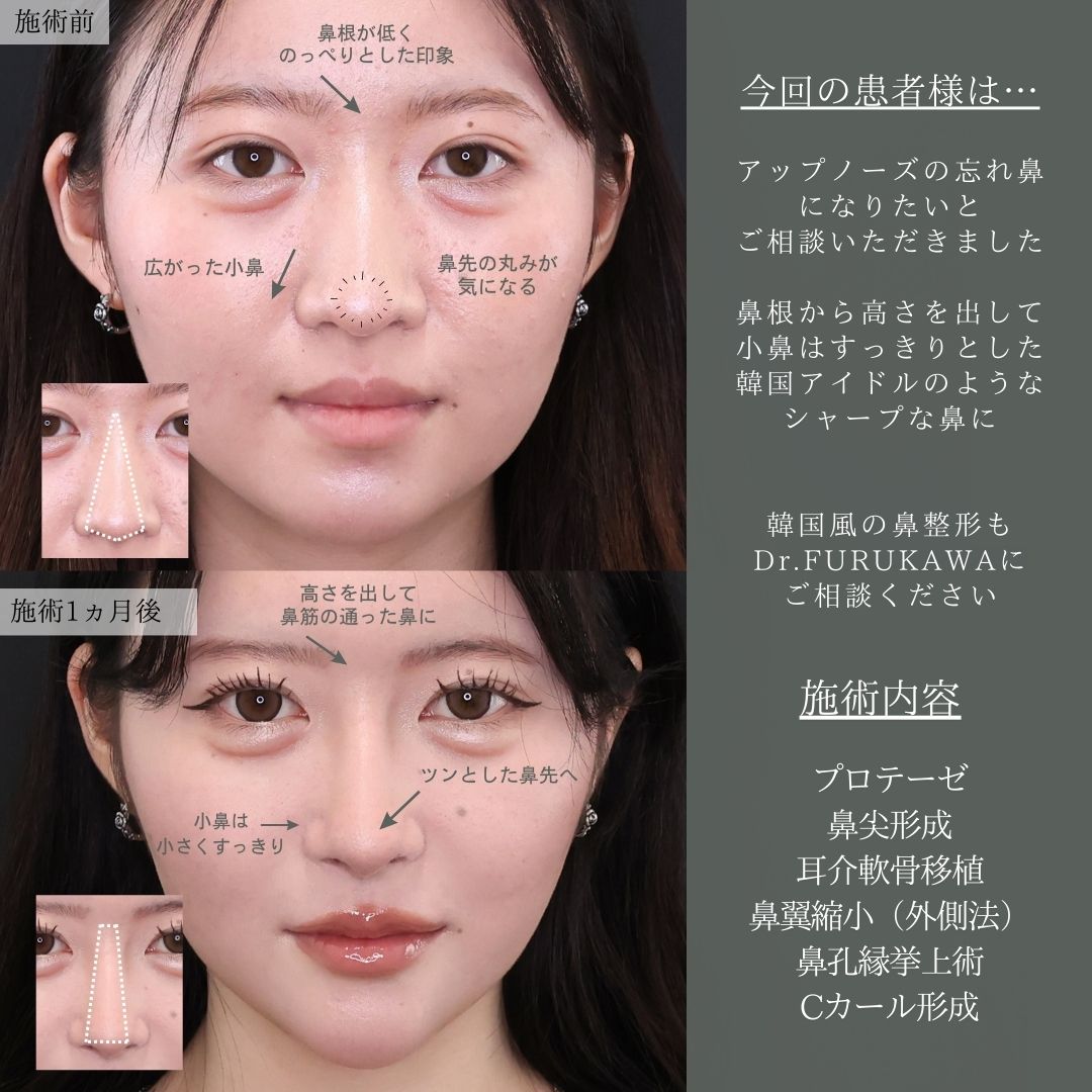鼻先軟骨移植/鼻尖形成・鼻尖縮小/隆鼻術（プロテーゼ・自家組織）の症例写真 施術前後 