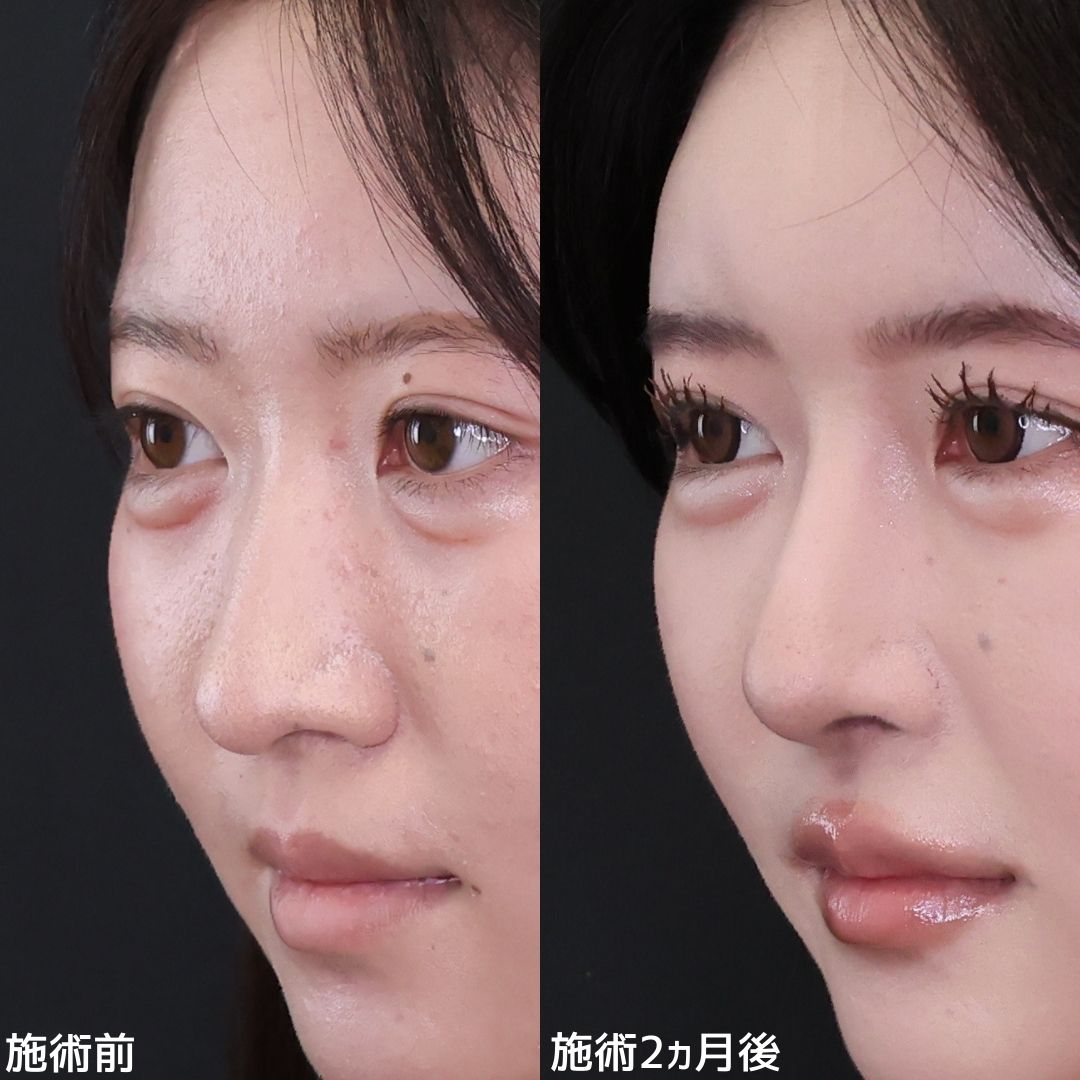 鼻先軟骨移植/鼻尖形成・鼻尖縮小/隆鼻術（プロテーゼ・自家組織）の症例写真 施術前後 