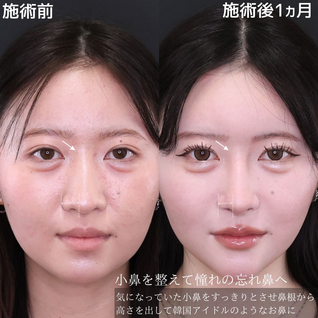 鼻先軟骨移植/鼻尖形成・鼻尖縮小/隆鼻術（プロテーゼ・自家組織）の症例写真 施術前後 