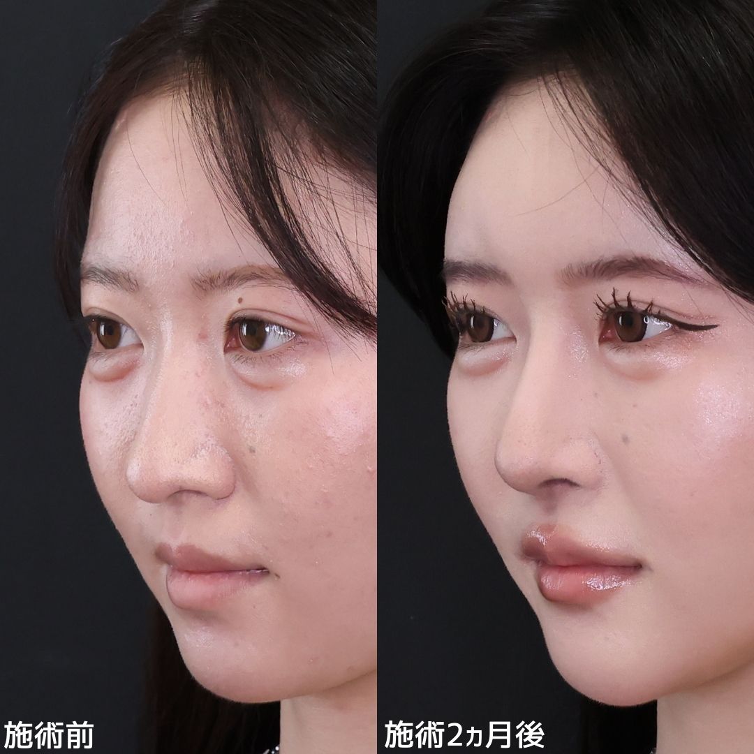 鼻先軟骨移植/鼻尖形成・鼻尖縮小/隆鼻術（プロテーゼ・自家組織）の症例写真 施術前後 