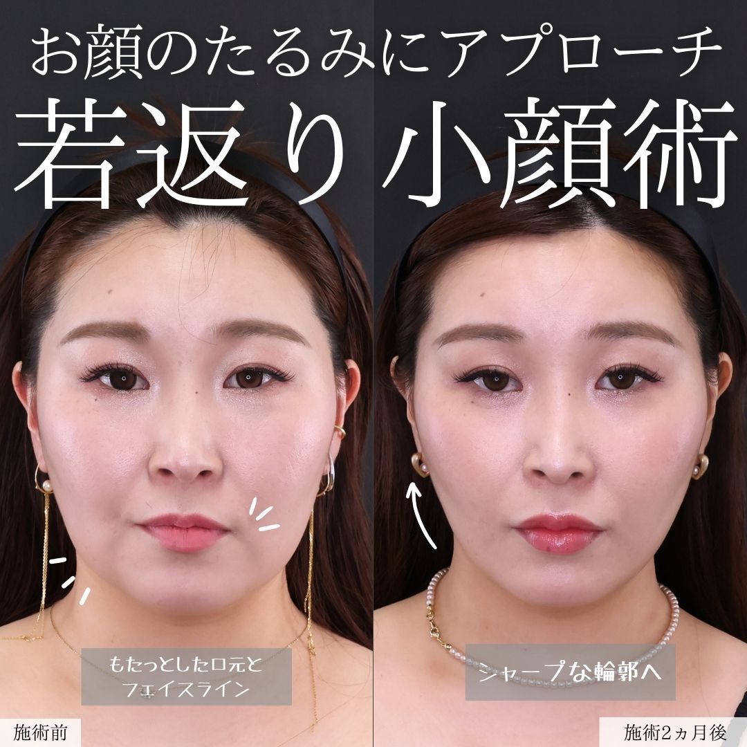 TAC式 ツヤ肌コラーゲンリフト®/ジョールファット除去/顔の脂肪吸引の症例写真 施術前後