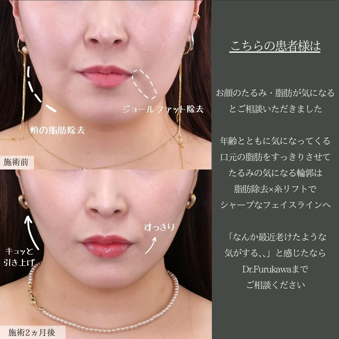 TAC式 ツヤ肌コラーゲンリフト®/ジョールファット除去/顔の脂肪吸引の症例写真 施術前後
