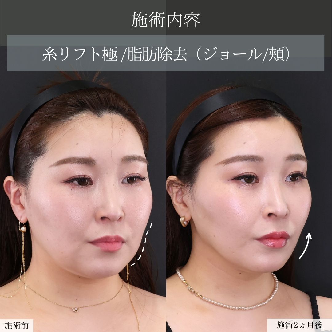 TAC式 ツヤ肌コラーゲンリフト®/ジョールファット除去/顔の脂肪吸引の症例写真 施術前後