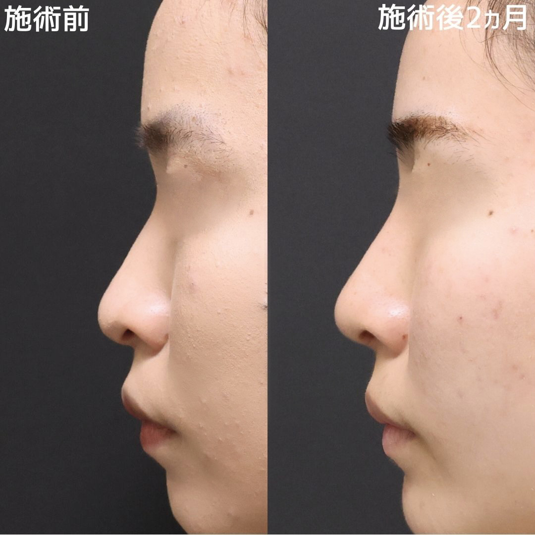 【小顔×鼻整形】コンプレックス解消で自信が持てるお顔に