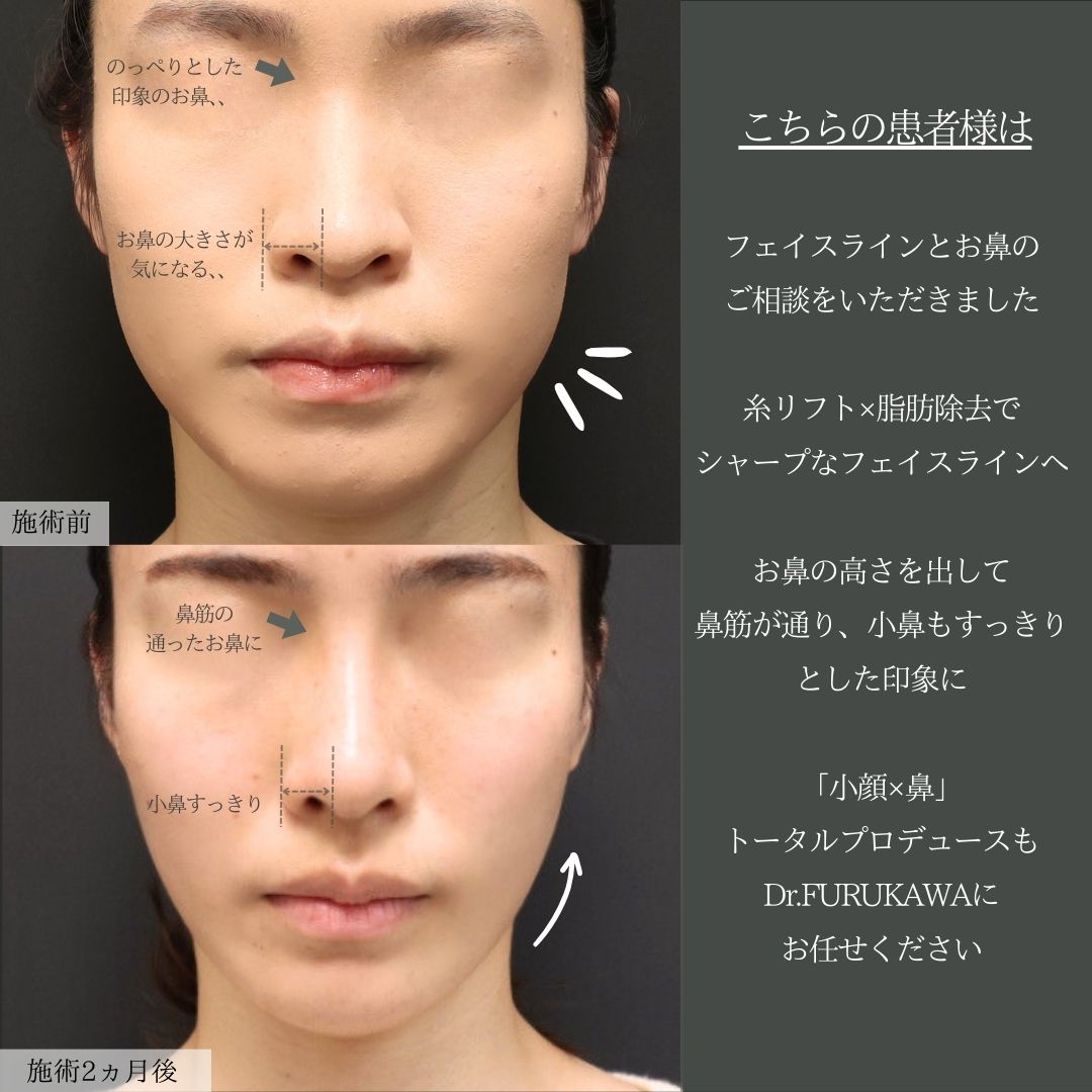 TAC式 ツヤ肌コラーゲンリフト®/ジョールファット除去/顔の脂肪吸引の症例写真 施術前後