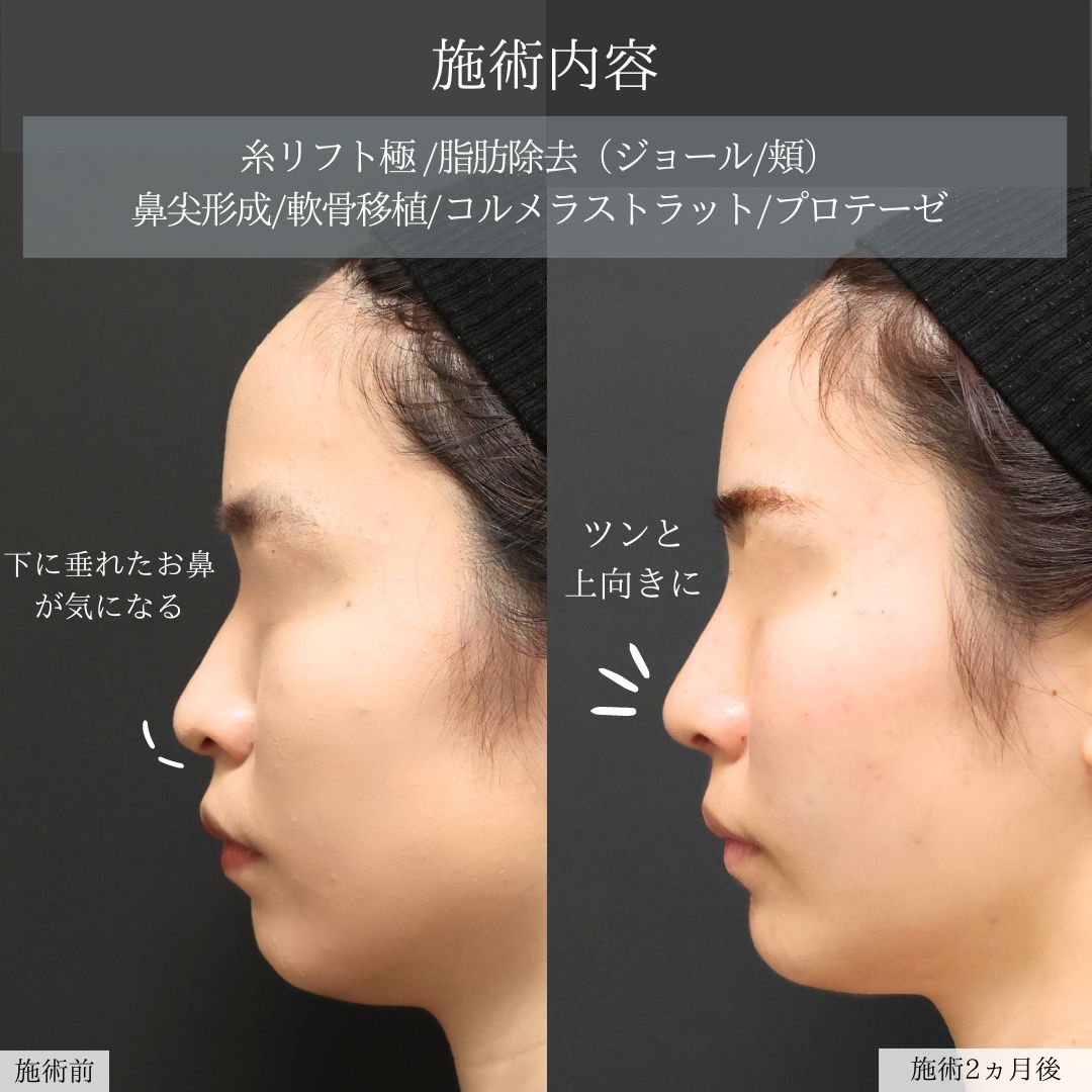 TAC式 ツヤ肌コラーゲンリフト®/ジョールファット除去/顔の脂肪吸引の症例写真 施術前後