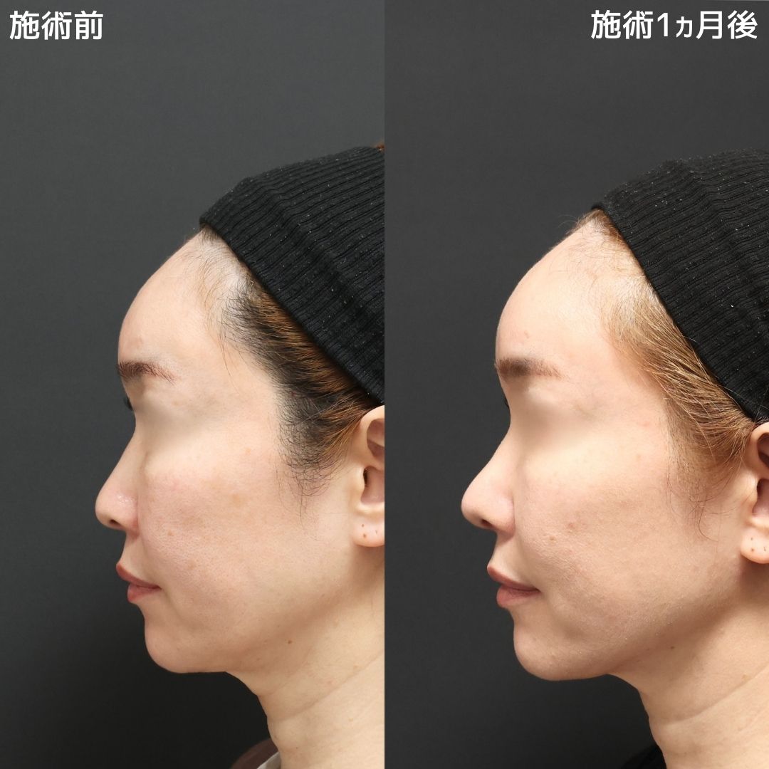 【鼻整形】横顔美人になる方法