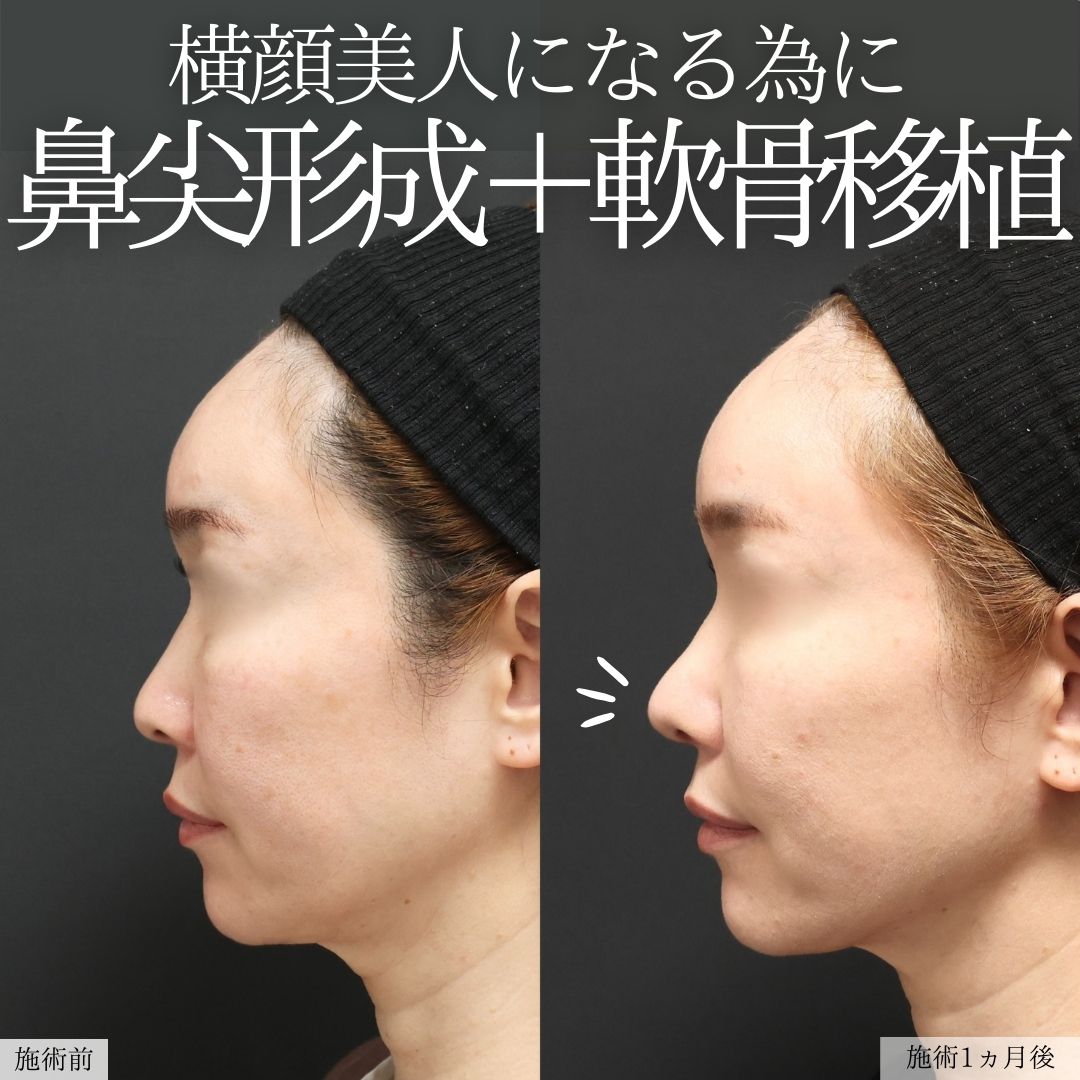 鼻尖形成・鼻尖縮小/鼻先軟骨移植の症例写真 施術前後 
