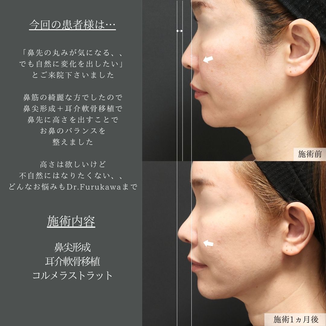鼻尖形成・鼻尖縮小/鼻先軟骨移植の症例写真 施術前後 