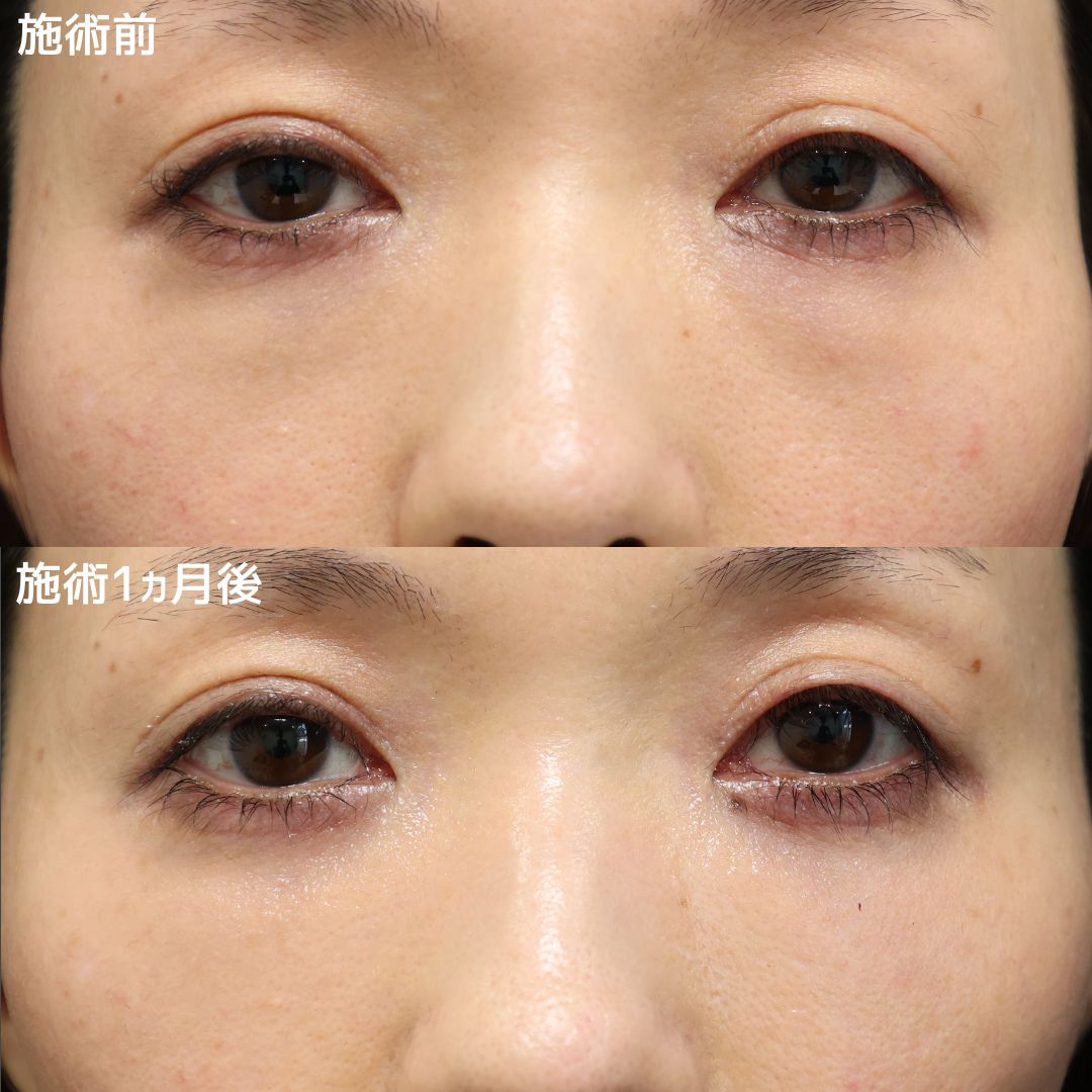 《クマ取り×脂肪注入》でナチュラルに若返り