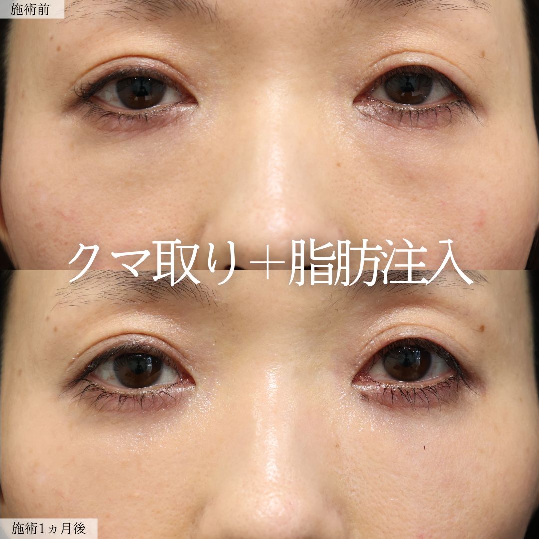 下眼瞼脱脂術（目の下のたるみ取り・目の下の脂肪ふくらみ取り）の症例写真 施術前後 