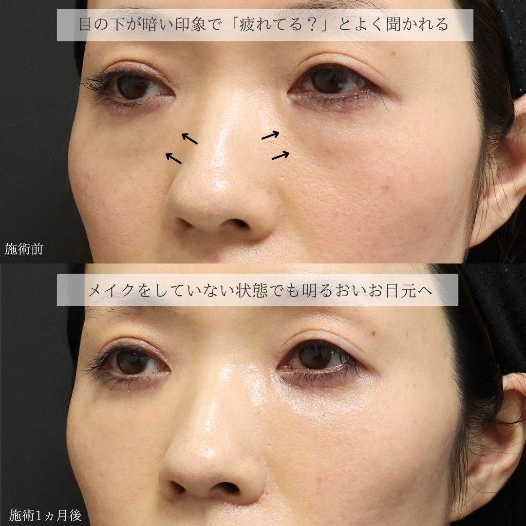 下眼瞼脱脂術（目の下のたるみ取り・目の下の脂肪ふくらみ取り）の症例写真 施術前後 