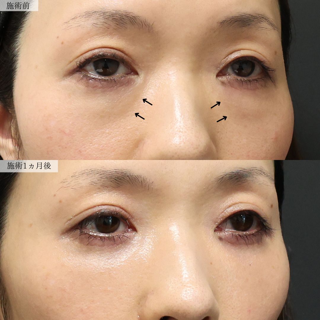 下眼瞼脱脂術（目の下のたるみ取り・目の下の脂肪ふくらみ取り）の症例写真 施術前後 