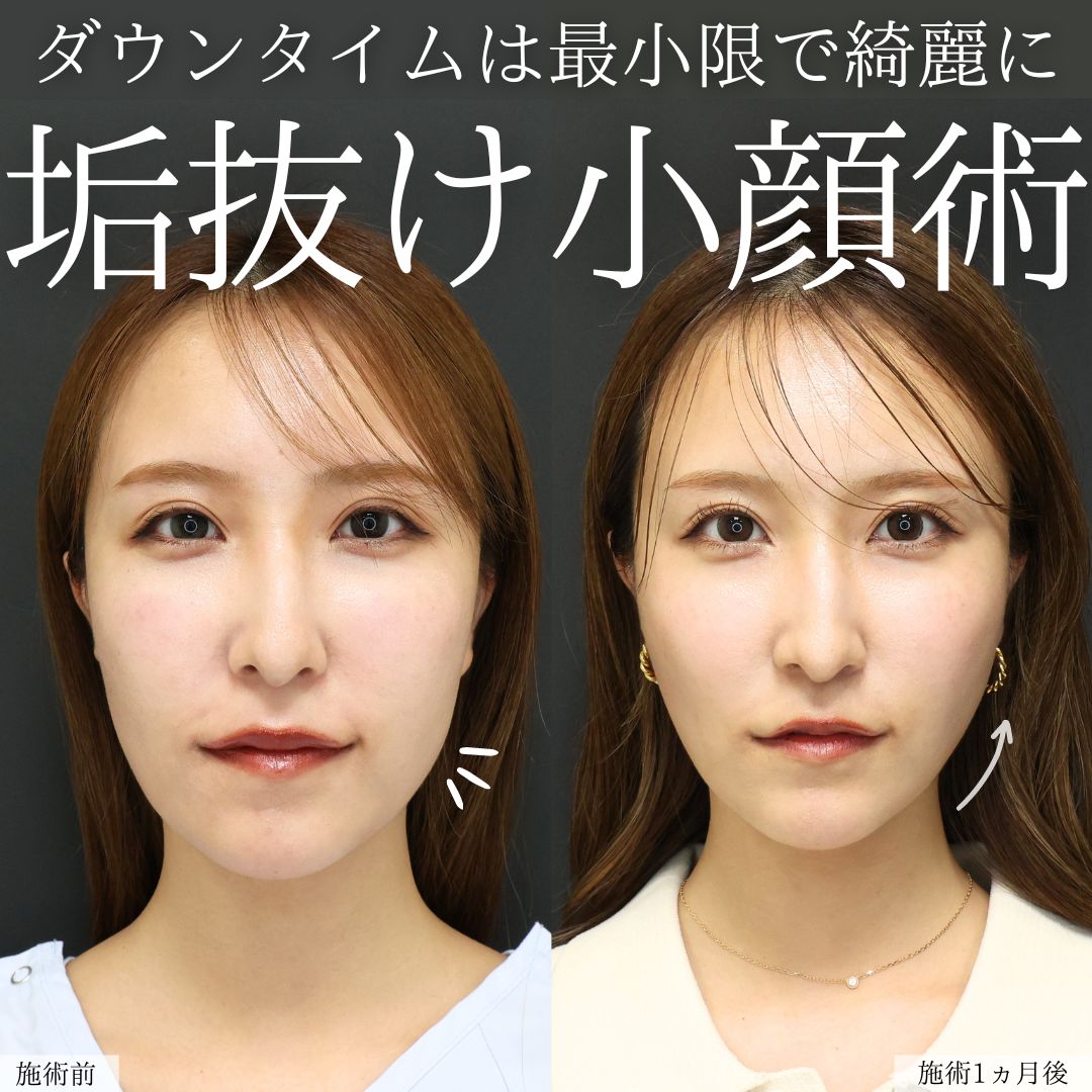 TAC式 ツヤ肌コラーゲンリフト®/顎のヒアルロン酸注射/ほうれい線のヒアルロン酸注射の症例写真 施術前後 