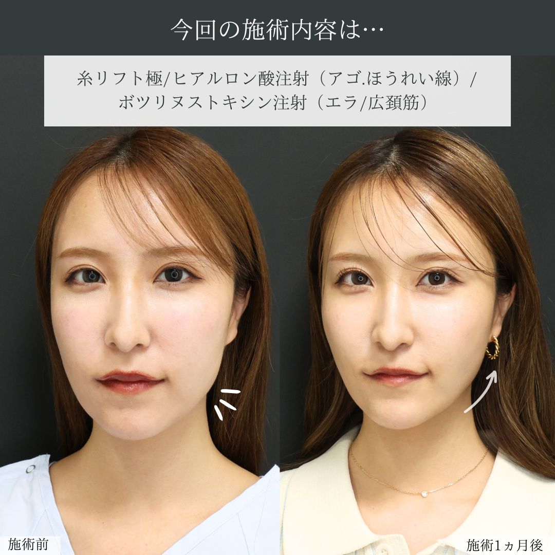 TAC式 ツヤ肌コラーゲンリフト®/顎のヒアルロン酸注射/ほうれい線のヒアルロン酸注射の症例写真 施術前後 