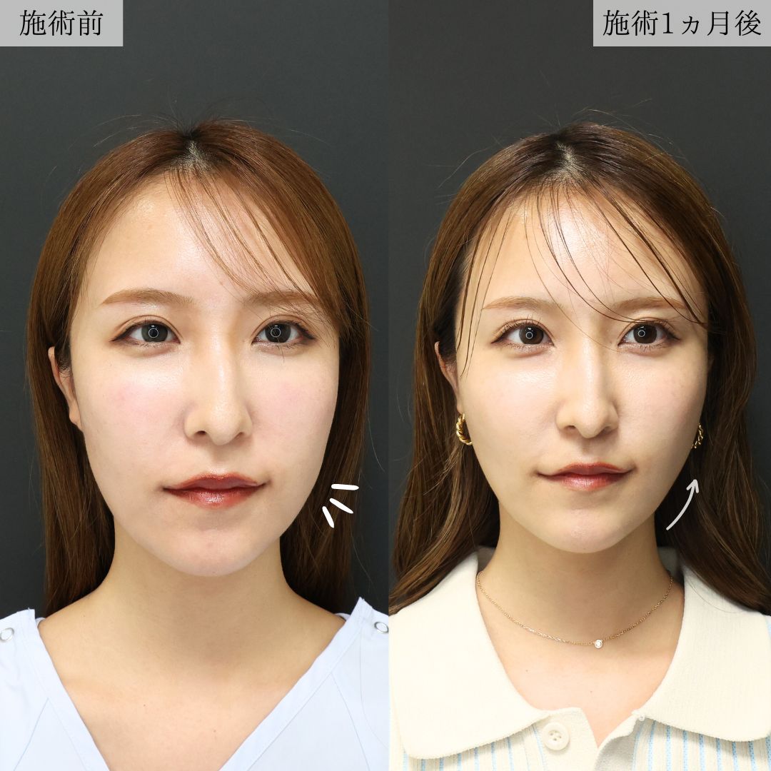 TAC式 ツヤ肌コラーゲンリフト®/顎のヒアルロン酸注射/ほうれい線のヒアルロン酸注射の症例写真 施術前後 