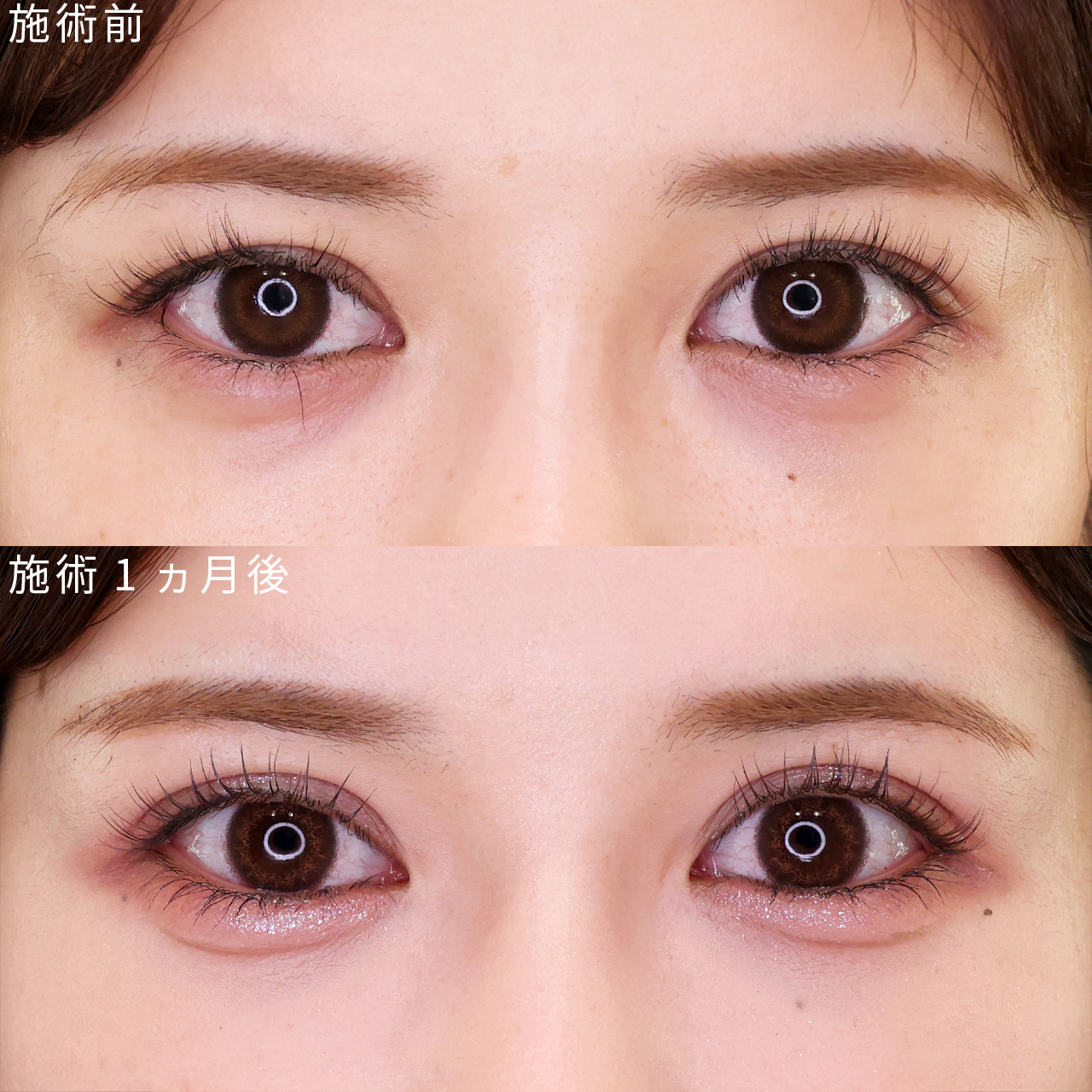 メイクが映える愛されEYEに【二重埋没】