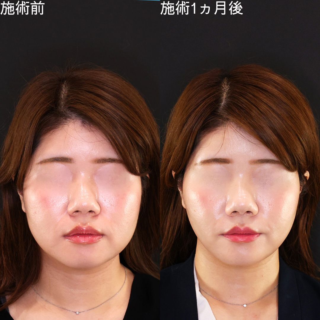 【糸リフト】脂肪吸引無し。糸リフトで小顔に導く！