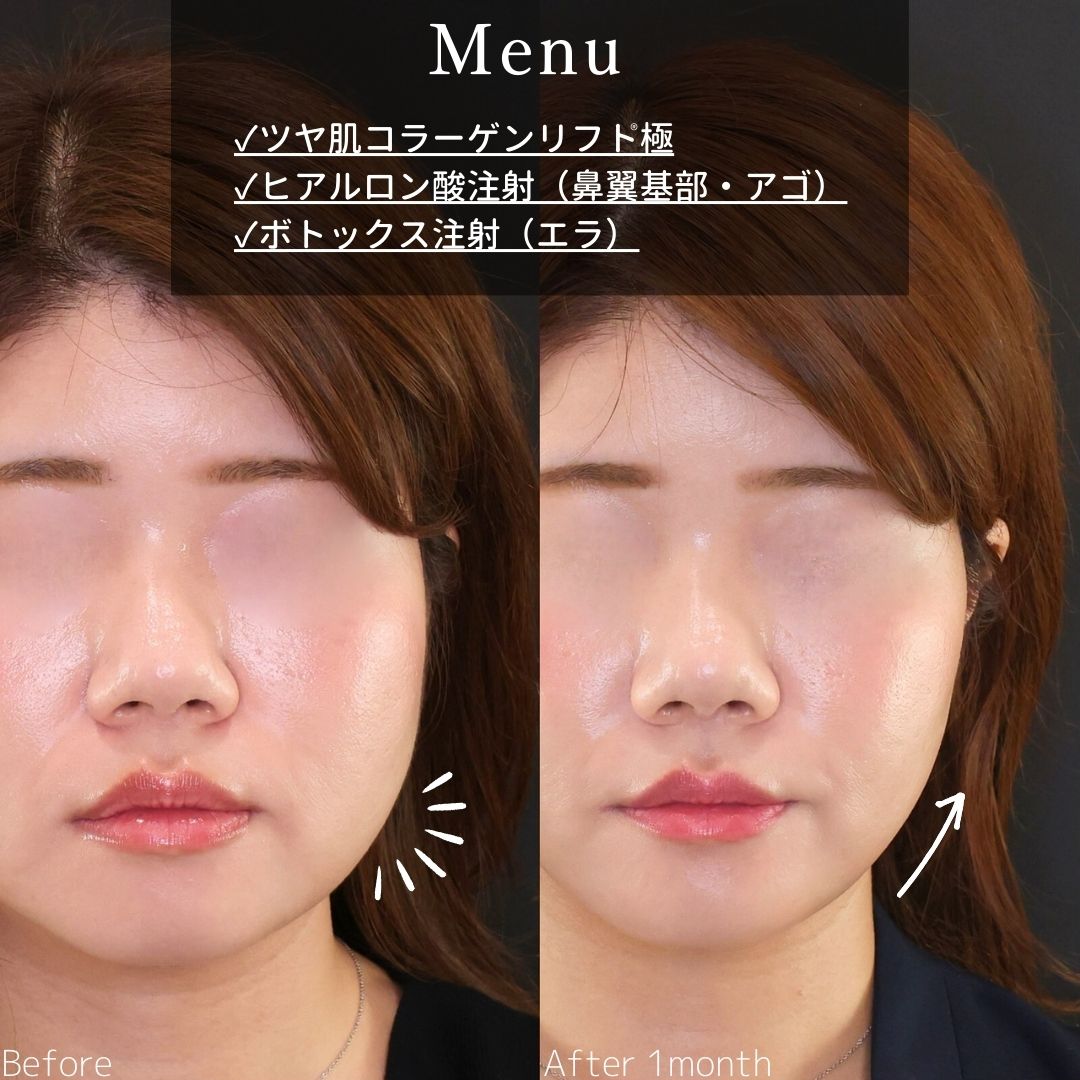 TAC式 ツヤ肌コラーゲンリフト®/顎のヒアルロン酸注射/エラボトックス注射の症例写真 施術前後 