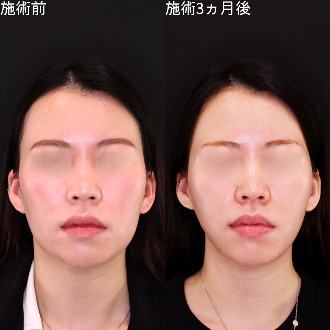 Dr.石橋の卵型輪郭形成術【糸リフト】