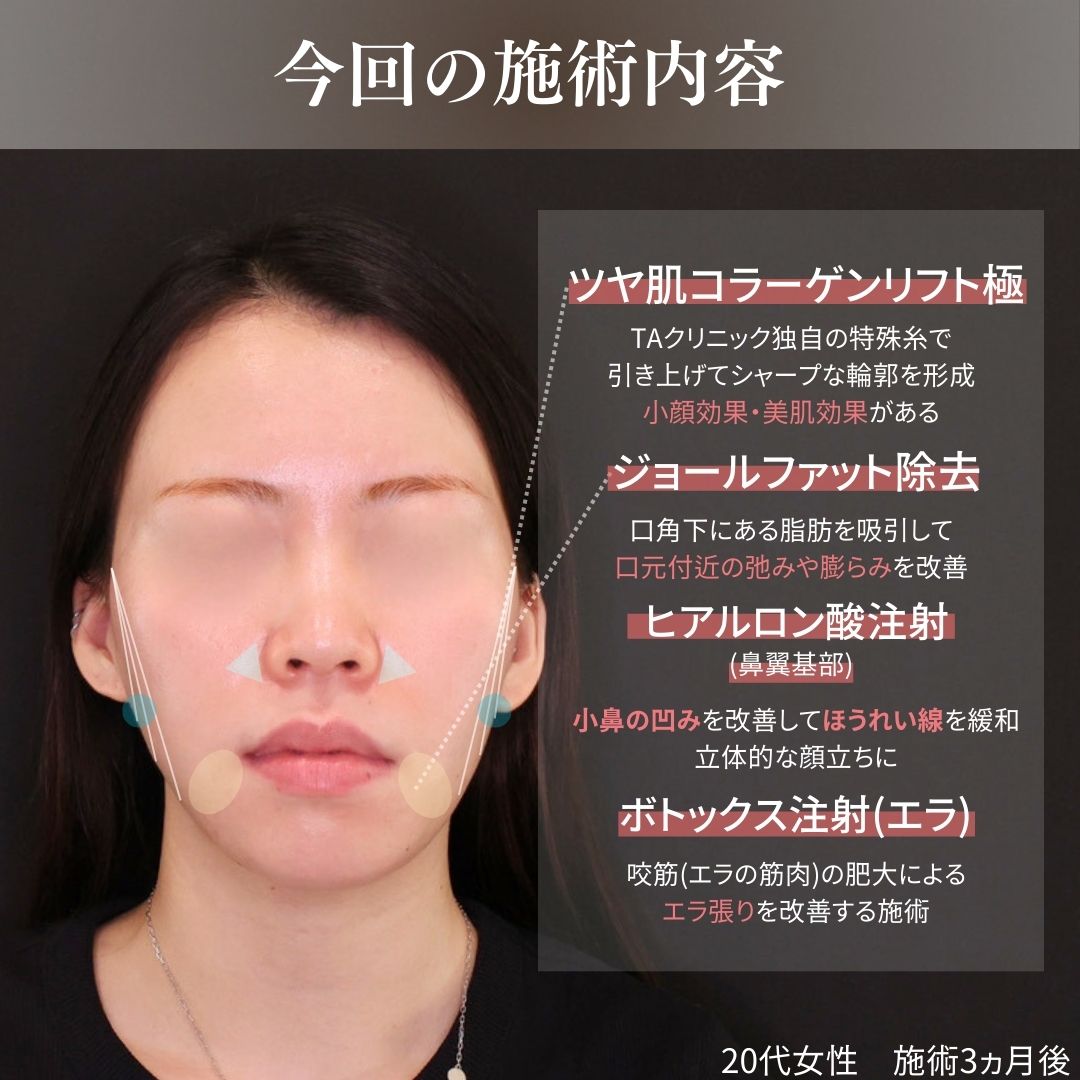 TAC式 ツヤ肌コラーゲンリフト®/ジョールファット除去/エラボトックス注射の症例写真 施術前後 