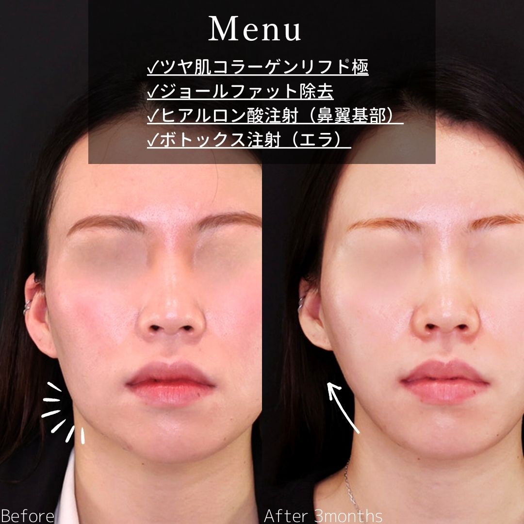 TAC式 ツヤ肌コラーゲンリフト®/ジョールファット除去/エラボトックス注射の症例写真 施術前後 