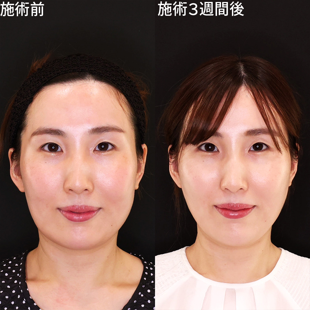 【糸リフト】糸リフトのみで輪郭を整える！