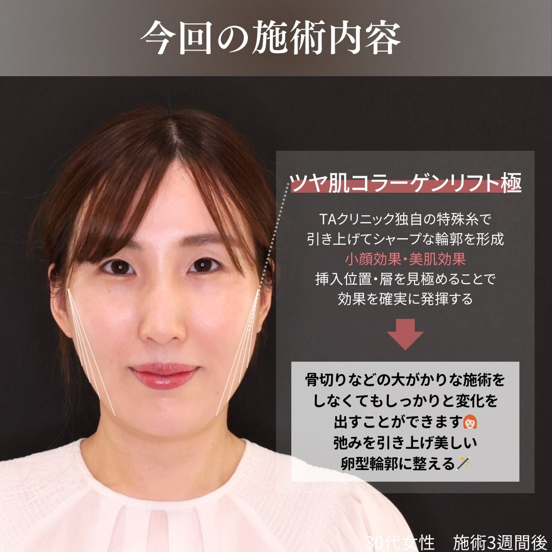 TAC式 ツヤ肌コラーゲンリフト®の症例写真 施術前後 